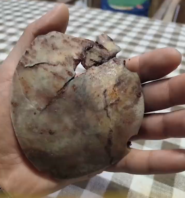 男子术后晒颅骨碎片：最薄之处像指甲 一捏就碎
