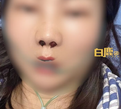 女生称因为爱抠鼻子 导致鼻内长了10多团真菌：胆小勿入