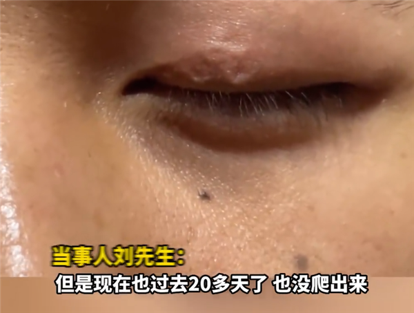 男子左眼皮异常抖动有虫游走:暂无治疗方案
