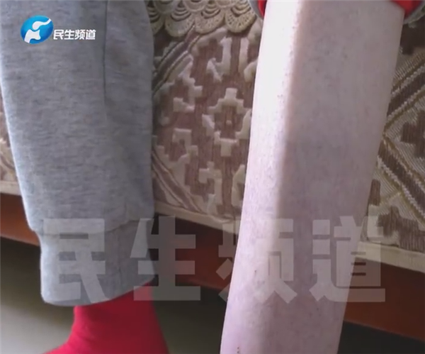 25岁女孩体重只有60多斤:脂肪几乎都没有了