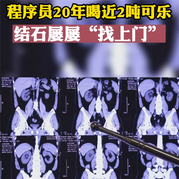 程序员20年喝近2吨可乐屡患结石 几乎天天喝